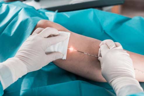 Laser endoveineux traitement des varices casablanca Maroc